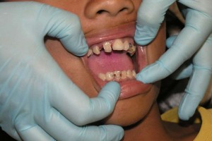 洗牙后牙结石长得快吗牙结石的危害有哪些
